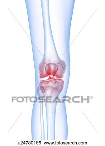 Stock Photography - Knee pain, conceptual illustration. Fotosearch