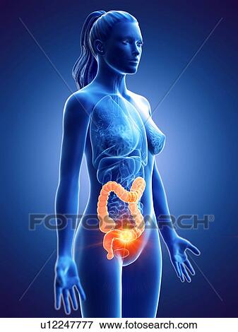 Large intestine, computer illustration. cancer View Large Photo Image Stock Photo - Large intestine, computer illustration. cancer. Fotosearch