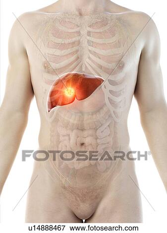 Stock Photo - Liver cancer, conceptual computer illustration.. Fotosearch