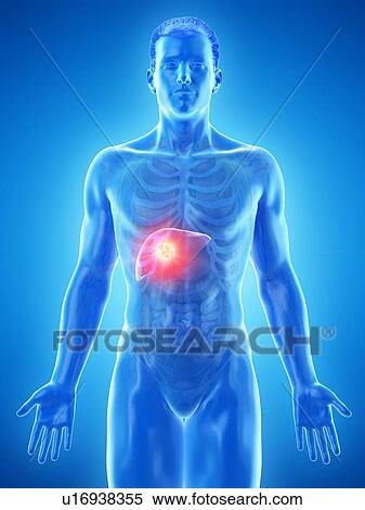 Stock Photography - Liver cancer, conceptual computer illustration.. Fotosearch