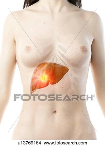 Liver cancer, conceptual illustration View Large Photo Image Picture - Liver cancer, conceptual illustration. Fotosearch