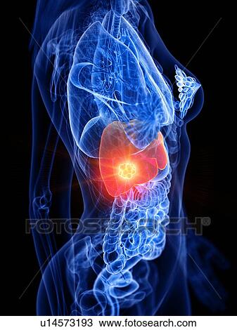 Liver cancer, conceptual illustration View Large Photo Image Stock Image - Liver cancer, conceptual illustration. Fotosearch