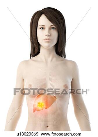 Liver cancer, conceptual illustration View Large Photo Image Stock Photo - Liver cancer, conceptual illustration. Fotosearch