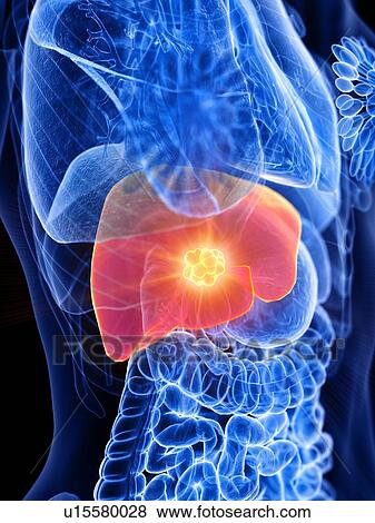 Stock Photo - Liver cancer, conceptual illustration. Fotosearch