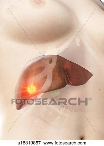 Stock Photo - Liver cancer, conceptual illustration. Fotosearch