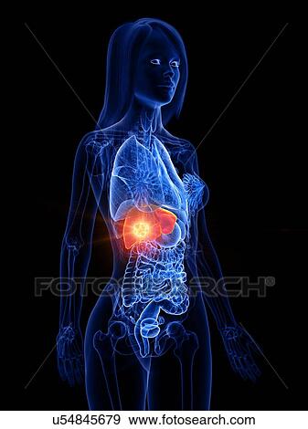 Liver cancer, conceptual illustration View Large Photo Image Stock Photo - Liver cancer, conceptual illustration. Fotosearch