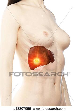 Stock Photography - Liver cancer, conceptual illustration. Fotosearch