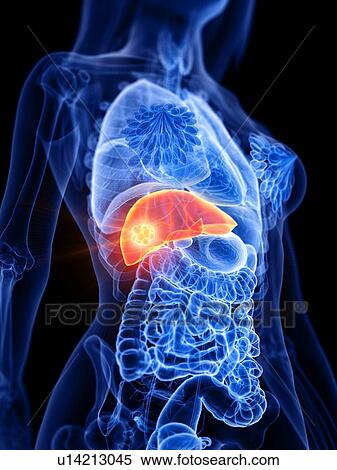 Liver cancer, conceptual illustration View Large Photo Image Stock Photography - Liver cancer, conceptual illustration. Fotosearch