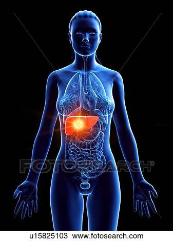 Stock Image - Liver, computer illustration. tumour. Fotosearch