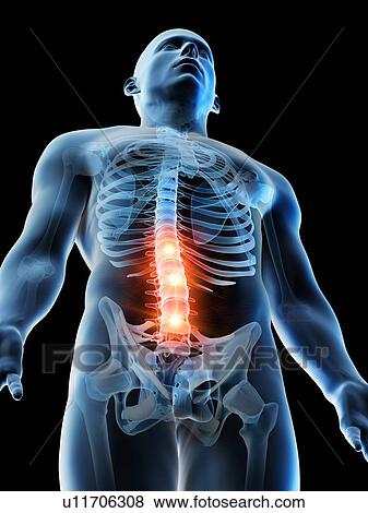 Stock Photo - Lower back pain, conceptual computer illustration.. Fotosearch