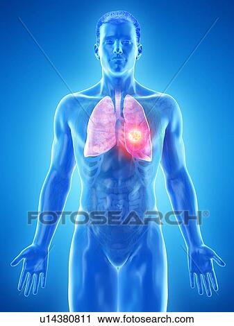 Lung cancer, conceptual computer illustration. View Large Photo Image Stock Image - Lung cancer, conceptual computer illustration.. Fotosearch