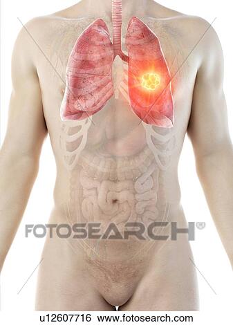 Lung cancer, conceptual computer illustration. View Large Photo Image Stock Photograph - Lung cancer, conceptual computer illustration.. Fotosearch