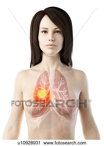 Lung cancer, conceptual illustration View Large Photo Image Stock Image - Lung cancer, conceptual illustration. Fotosearch
