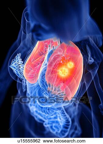 Lung cancer, conceptual illustration View Large Photo Image Stock Image - Lung cancer, conceptual illustration. Fotosearch