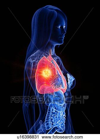 Stock Image - Lung cancer, conceptual illustration. Fotosearch