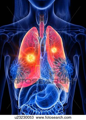 Stock Image - Lung cancer, conceptual illustration. Fotosearch