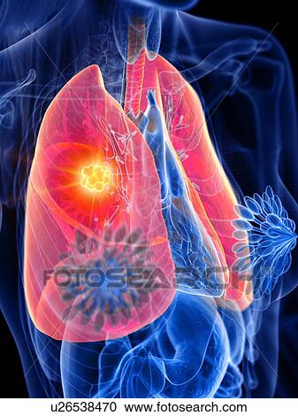 Lung cancer, conceptual illustration View Large Photo Image Stock Image - Lung cancer, conceptual illustration. Fotosearch