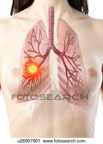 Stock Image - Lung cancer, conceptual illustration. Fotosearch