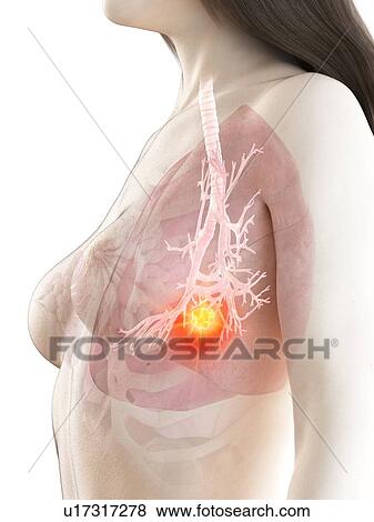 Lung cancer, conceptual illustration View Large Photo Image Stock Photo - Lung cancer, conceptual illustration. Fotosearch