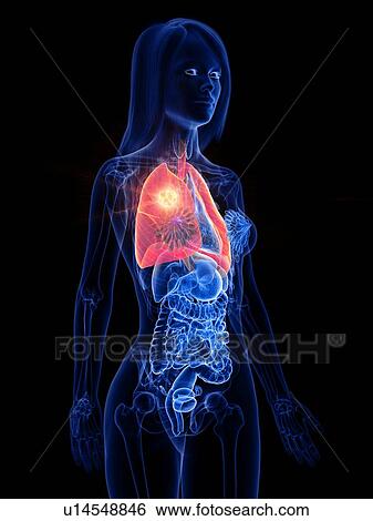 Lung cancer, conceptual illustration View Large Photo Image Stock Photograph - Lung cancer, conceptual illustration. Fotosearch