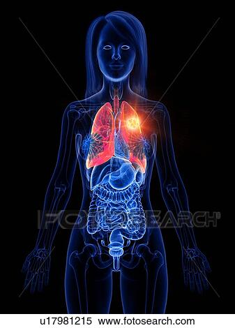 Lung cancer, conceptual illustration View Large Photo Image Stock Photography - Lung cancer, conceptual illustration. Fotosearch