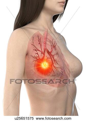 Lung cancer, conceptual illustration View Large Photo Image Stock Photography - Lung cancer, conceptual illustration. Fotosearch