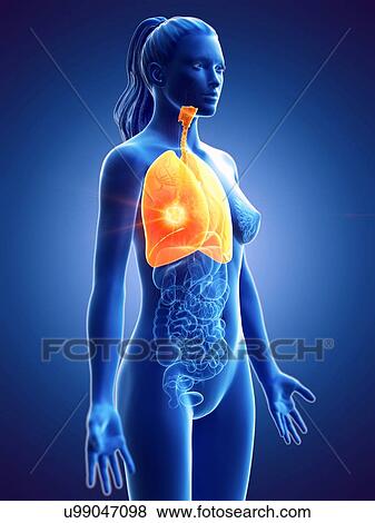 Stock Photo - Lung, computer illustration. cancer. Fotosearch