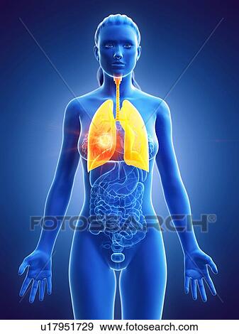 Lung, computer illustration. tumour View Large Photo Image Stock Photo - Lung, computer illustration. tumour. Fotosearch
