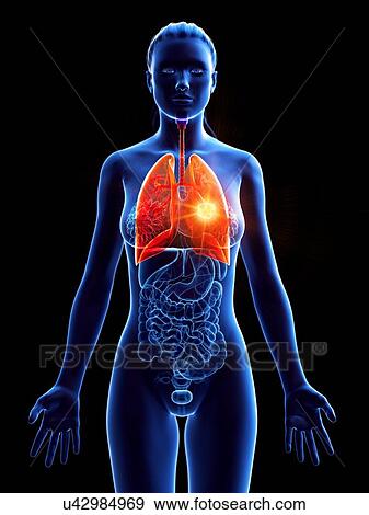 Stock Photo - Lung, computer illustration. tumour. Fotosearch