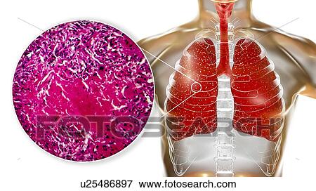 Stock Photo - Miliary tuberculosis, computer illustration and light micrograph. Miliary tuberculosis is a result of hematogenous dissemination of Mycobacterium tuberculosis bacteria producing myriads of small tuberculosis granulomatous lesions throughout the lung.... Fotosearch