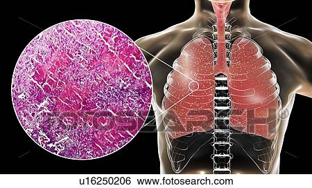 Miliary tuberculosis, computer illustration and light micrograph. Miliary tuberculosis is a result of hematogenous dissemination of Mycobacterium tuberculosis bacteria producing myriads of small tuberculosis granulomatous lesions throughout the lung... View Large Photo Image Stock Photograph - Miliary tuberculosis, computer illustration and light micrograph. Miliary tuberculosis is a result of hematogenous dissemination of Mycobacterium tuberculosis bacteria producing myriads of small tuberculosis granulomatous lesions throughout the lung.... Fotosearch