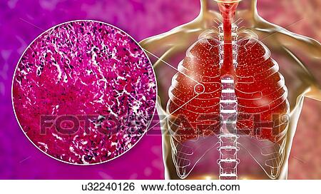 Stock Photograph - Miliary tuberculosis, computer illustration and light micrograph. Miliary tuberculosis is a result of hematogenous dissemination of Mycobacterium tuberculosis bacteria producing myriads of small tuberculosis granulomatous lesions throughout the lung.... Fotosearch