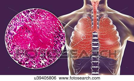 Stock Photograph - Miliary tuberculosis, computer illustration and light micrograph. Miliary tuberculosis is a result of hematogenous dissemination of Mycobacterium tuberculosis bacteria producing myriads of small tuberculosis granulomatous lesions throughout the lung.... Fotosearch