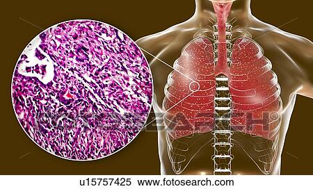 Miliary tuberculosis, computer illustration and light micrograph. Miliary tuberculosis is a result of hematogenous dissemination of Mycobacterium tuberculosis bacteria producing myriads of small tuberculosis granulomatous lesions throughout the lung... View Large Photo Image Stock Photography - Miliary tuberculosis, computer illustration and light micrograph. Miliary tuberculosis is a result of hematogenous dissemination of Mycobacterium tuberculosis bacteria producing myriads of small tuberculosis granulomatous lesions throughout the lung.... Fotosearch