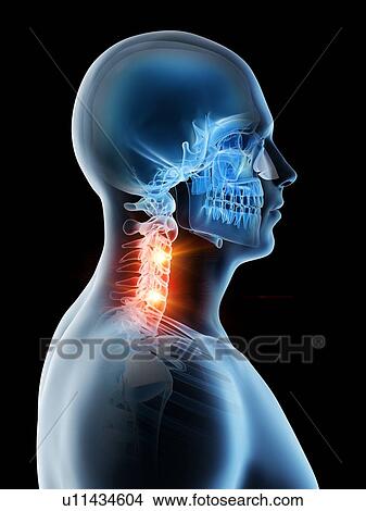 Neck pain, conceptual computer illustration. View Large Photo Image Picture - Neck pain, conceptual computer illustration.. Fotosearch