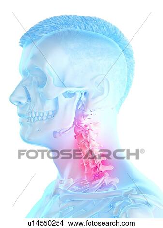 Picture - Neck pain, conceptual computer illustration.. Fotosearch