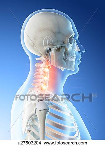 Picture - Neck pain, conceptual computer illustration.. Fotosearch