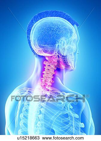 Stock Image - Neck pain, conceptual computer illustration.. Fotosearch