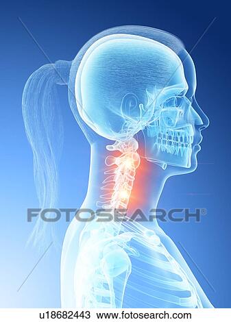 Neck pain, conceptual computer illustration. View Large Photo Image Stock Image - Neck pain, conceptual computer illustration.. Fotosearch