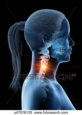 Stock Image - Neck pain, conceptual computer illustration.. Fotosearch