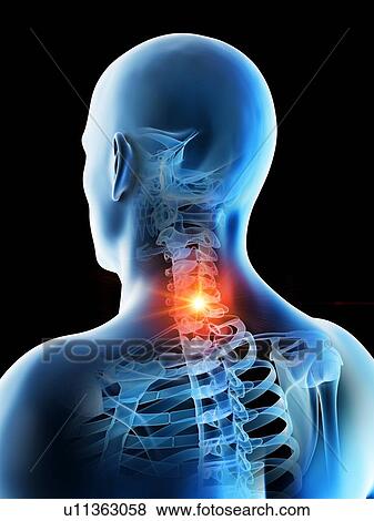 Stock Photo - Neck pain, conceptual computer illustration.. Fotosearch