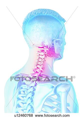 Stock Photo - Neck pain, conceptual computer illustration.. Fotosearch