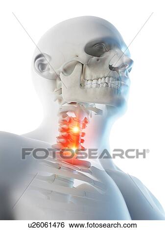 Stock Photograph - Neck pain, conceptual computer illustration.. Fotosearch