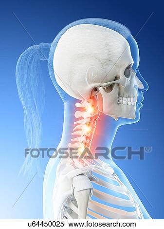Stock Photography - Neck pain, conceptual computer illustration.. Fotosearch