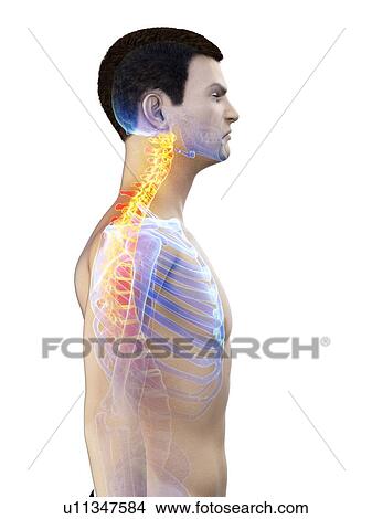 Picture - Neck pain, conceptual illustration.. Fotosearch