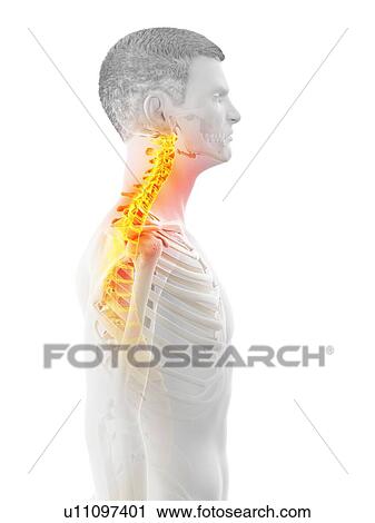 Stock Image - Neck pain, conceptual illustration.. Fotosearch