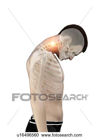 Stock Image - Neck pain, conceptual illustration.. Fotosearch