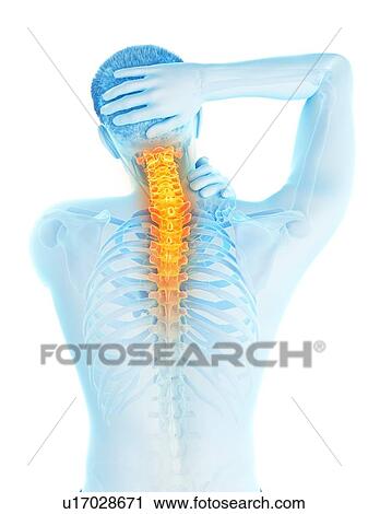 Stock Image - Neck pain, conceptual illustration.. Fotosearch