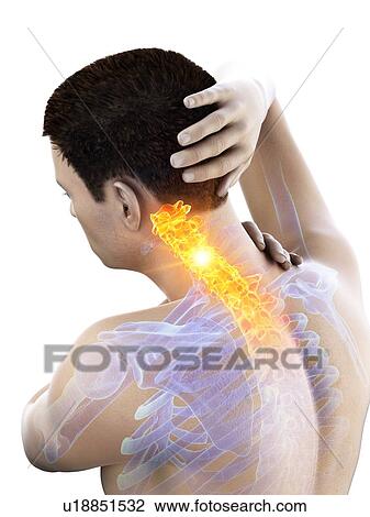 Stock Image - Neck pain, conceptual illustration.. Fotosearch