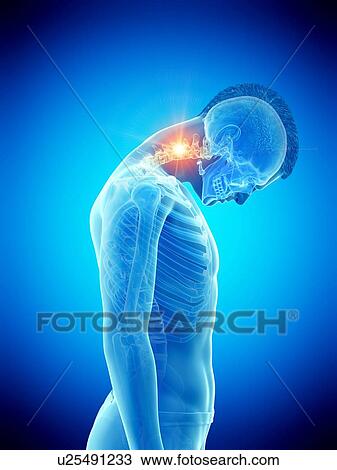 Stock Image - Neck pain, conceptual illustration.. Fotosearch
